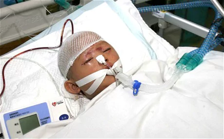 Death of Wang Yue Chinese toddler undergoes emergency surgery as condition