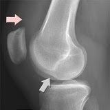 Deep lateral femoral notch sign