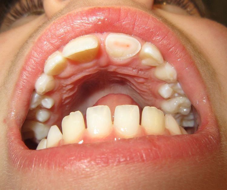 Dental trauma