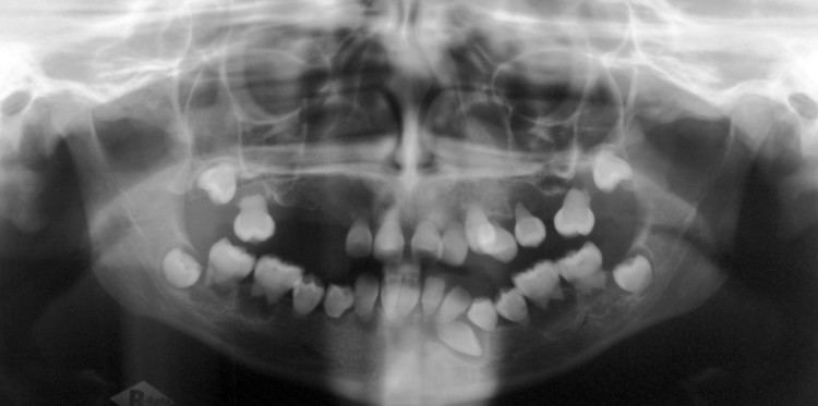 Dentin dysplasia