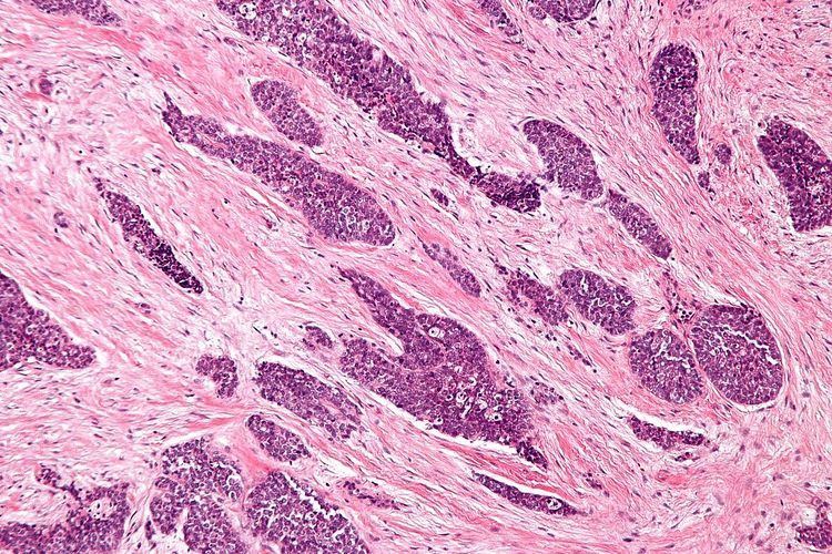 Desmoplastic small-round-cell tumor