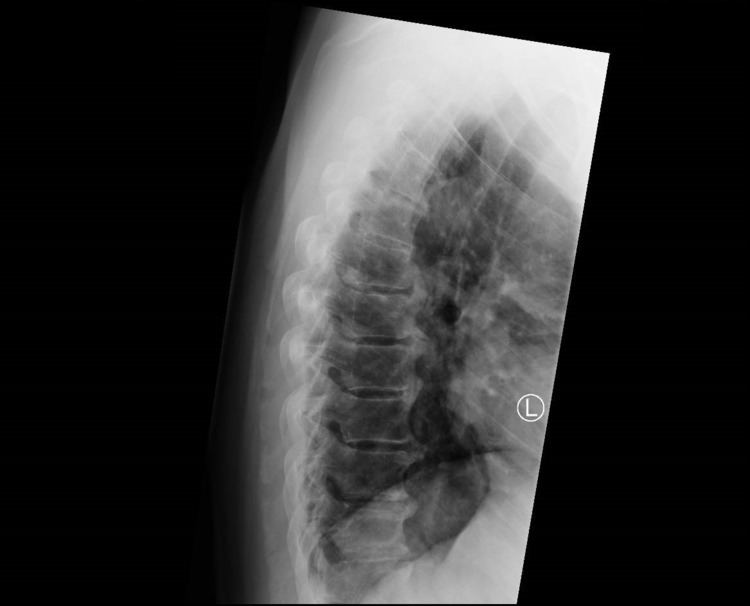 Diffuse idiopathic skeletal hyperostosis