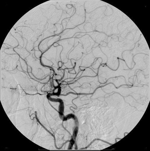 Digital subtraction angiography