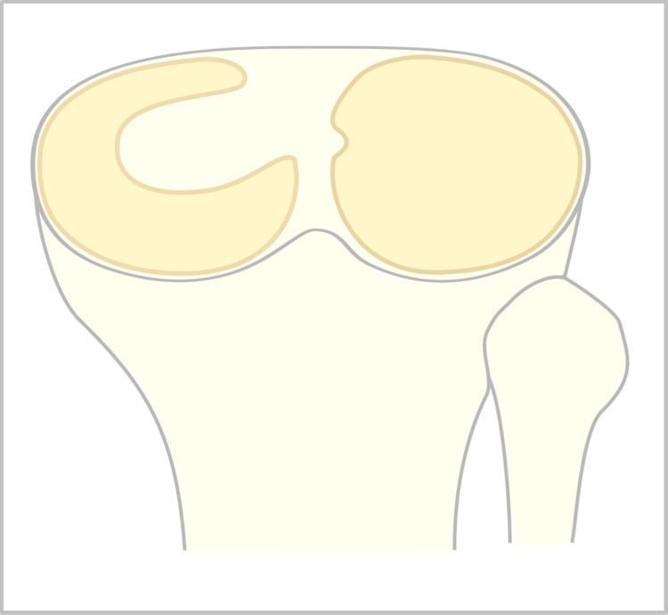 Discoid meniscus