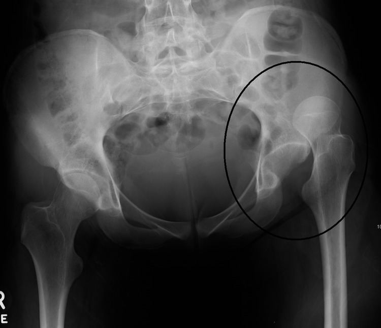 Dislocation of hip
