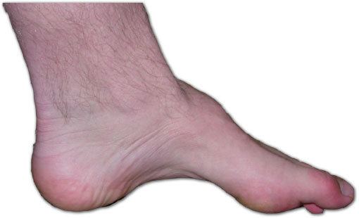 Distal hereditary motor neuropathy type V