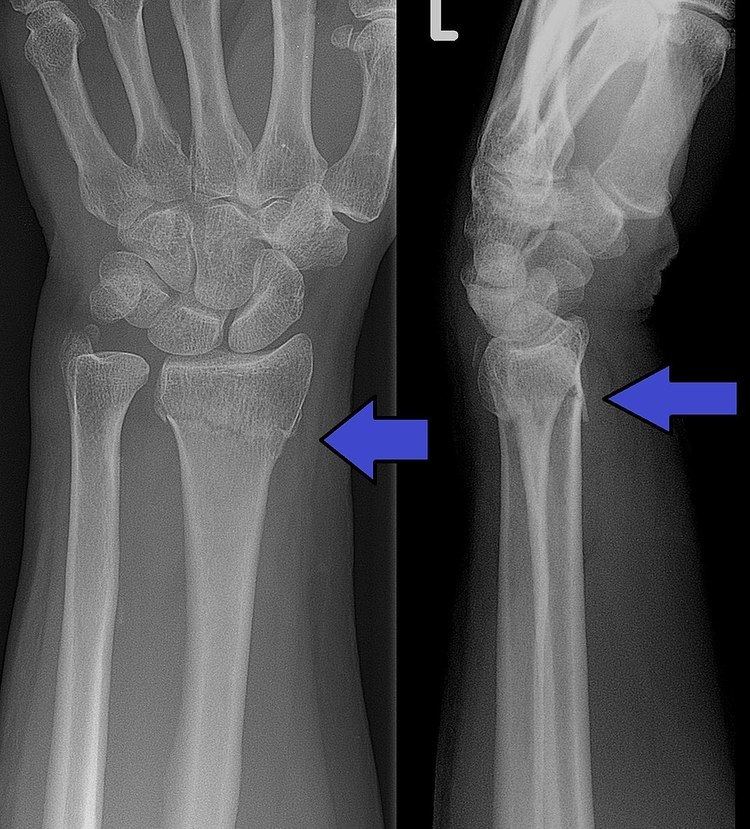 Distal radius fracture