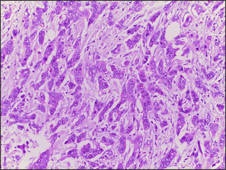Ductal carcinoma