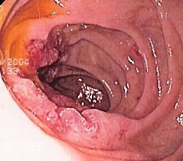 Duodenal cancer