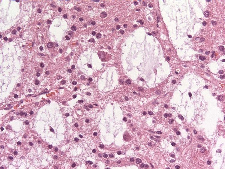 Dysembryoplastic neuroepithelial tumour