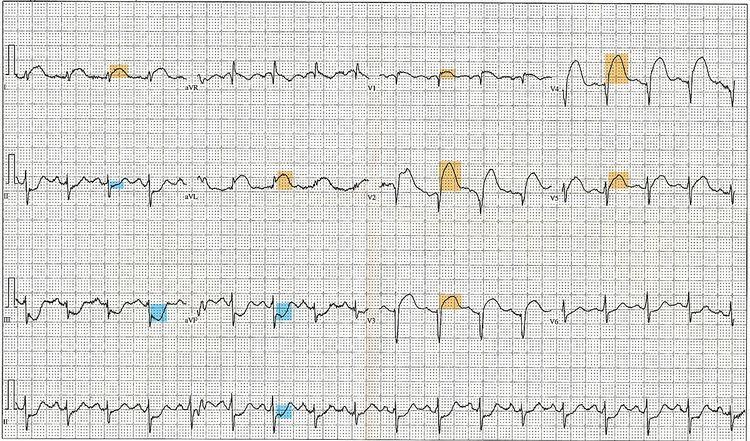 Electrocardiography in myocardial infarction