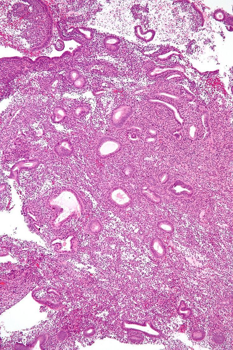 Endometrial biopsy