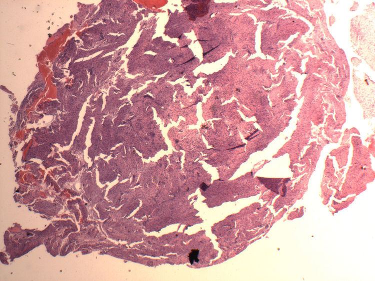 Endometrial stromal nodule