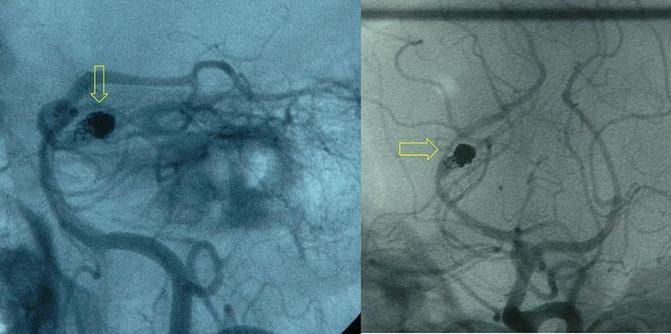 Endovascular coiling