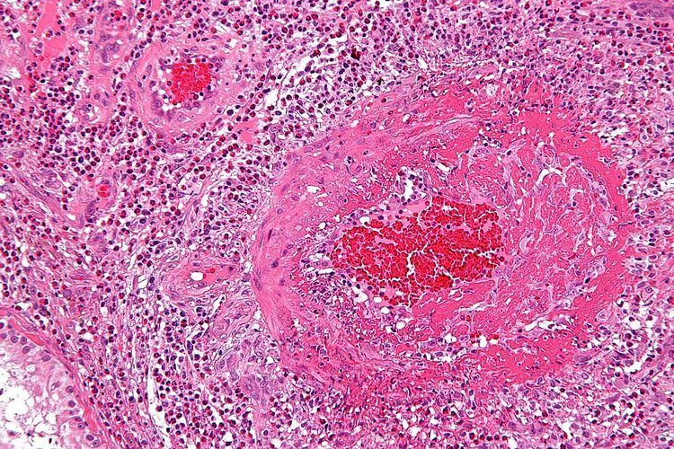 Eosinophilic granulomatosis with polyangiitis