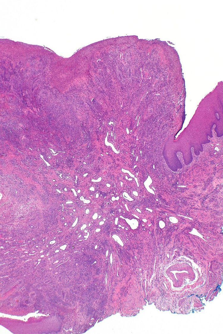 Eosinophilic ulcer of the oral mucosa