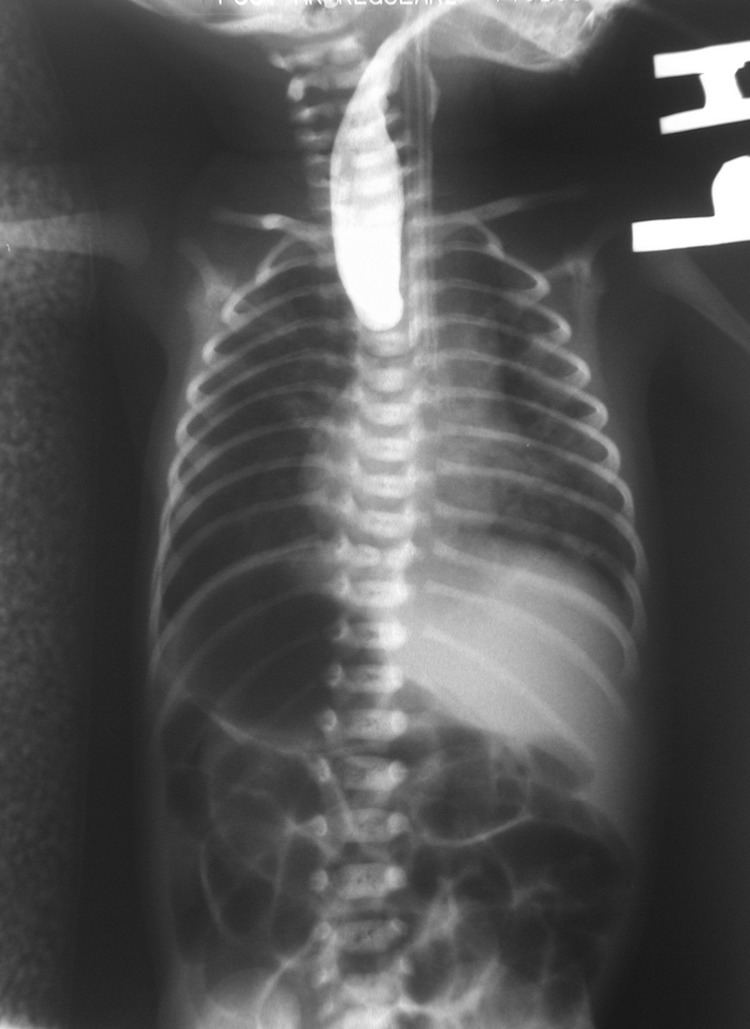 Esophageal atresia