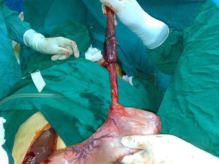Esophagectomy