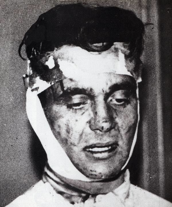 Eugen Weidmann with bruises on his face