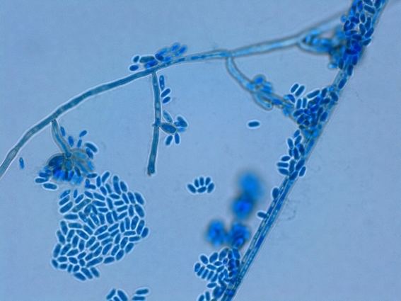 Exophiala Fun With Microbiology What39s Buggin39 You Exophiala dermatitidis