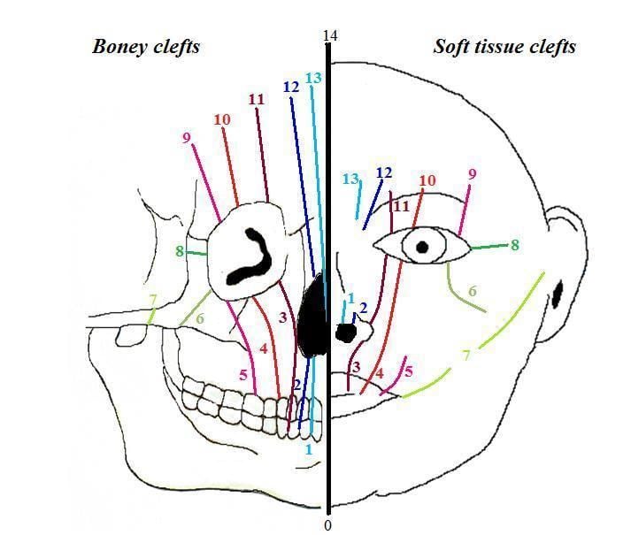 Facial cleft