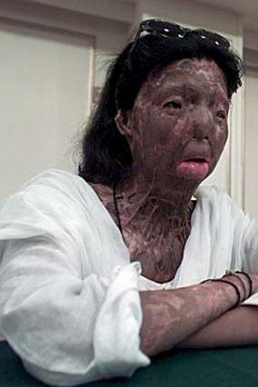 A life destroyed by cowardly acid attack