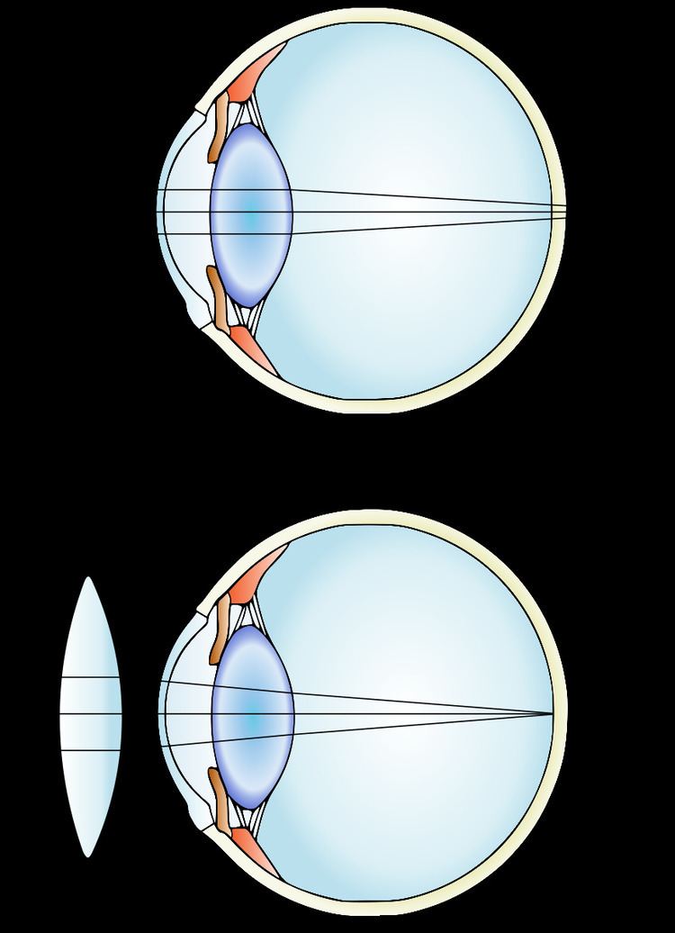 Линзы для зрения дальнозоркость. Миопия и гиперметропия линзы. Близорукость и дальнозоркость линзы. Линзы при гиперметропии. Миопия глаза дальнозоркость.