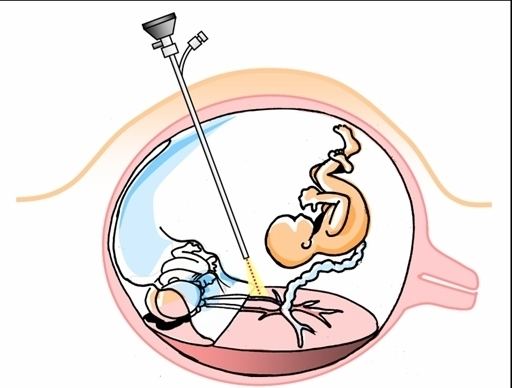 Fetal surgery