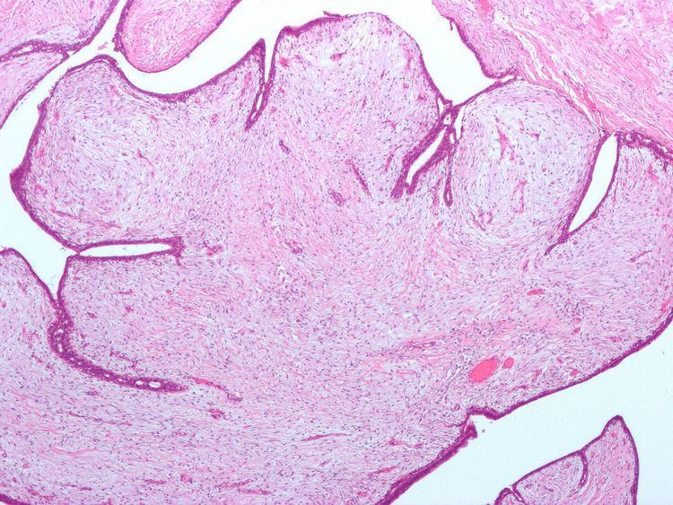 Fibroepithelial neoplasms