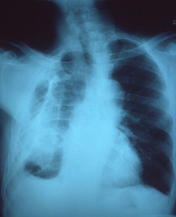 Fibrothorax