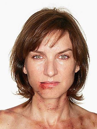 Fiona Bruce with short blonde hair and bruises on her face and neck.