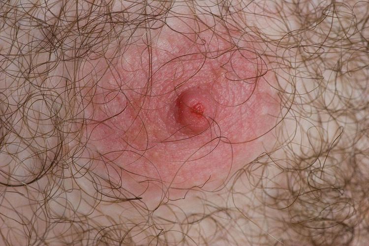 Fissure of the nipple