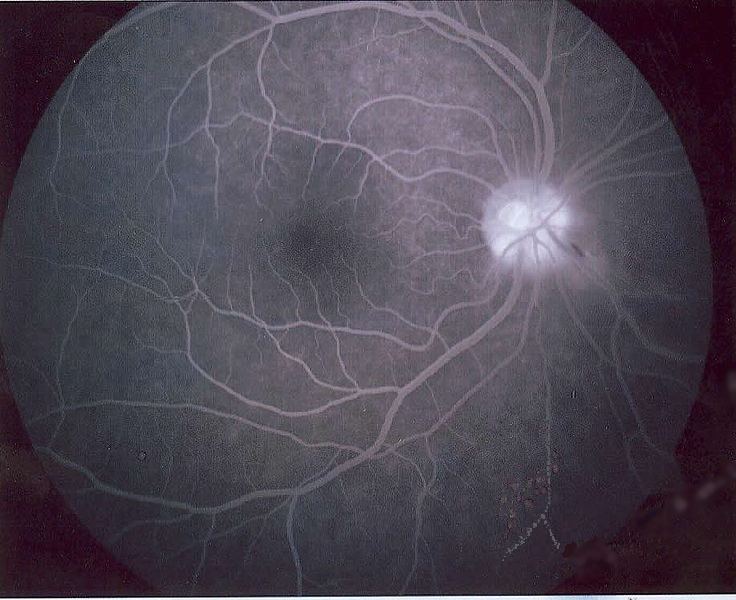 Fluorescein angiography