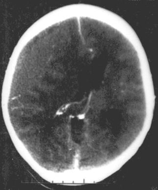 Focal and diffuse brain injury