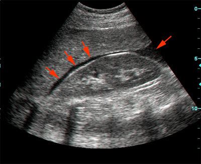 Focused assessment with sonography for trauma