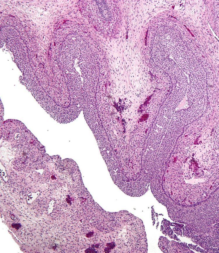 Follicular cyst of ovary