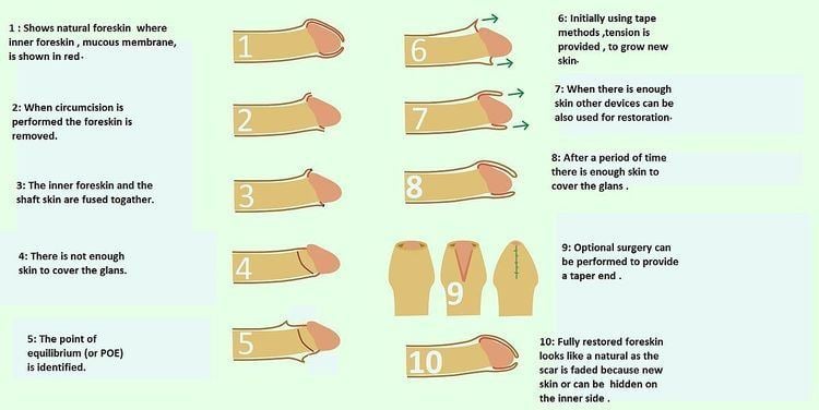 10 steps of Foreskin restoration