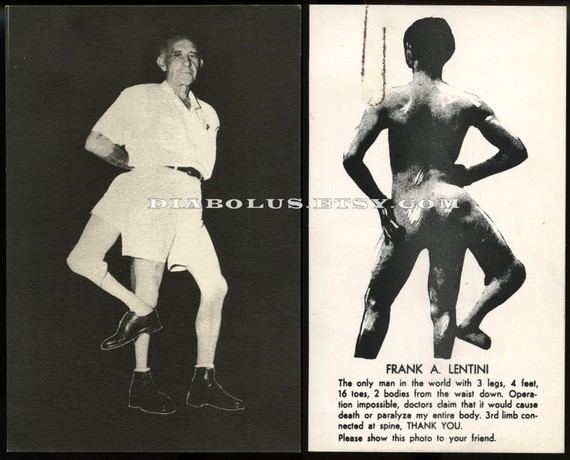 On the left, Frank Lentini, the three-leg man, smiling while wearing a polo shirt, shorts with a belt, socks, and shoes. On the right, Frank showing his naked back while on the bottom right are some information about him