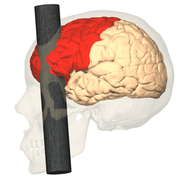 Frontal lobe injury Frontal lobe injury