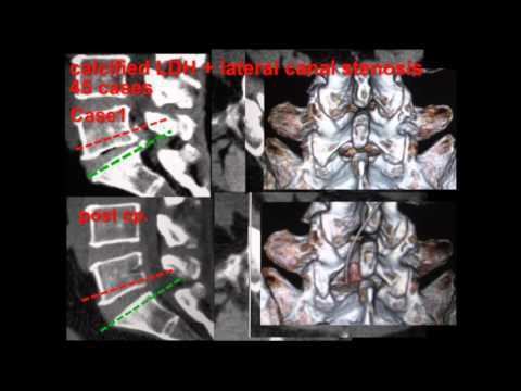 Fujio Ito Percutaneous endoscopic laminectomy Fujio Ito MD YouTube