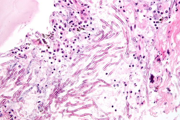 Fungal pneumonia