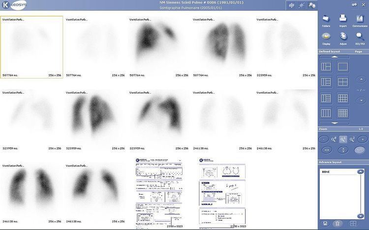 Gamma camera