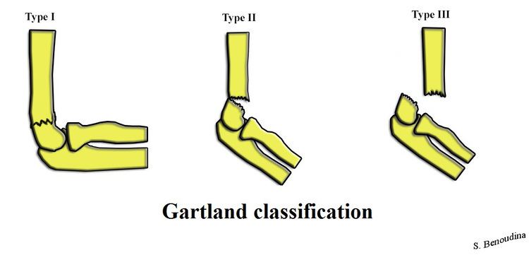 Gartland classification