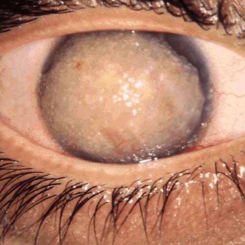 Gelatinous drop-like corneal dystrophy