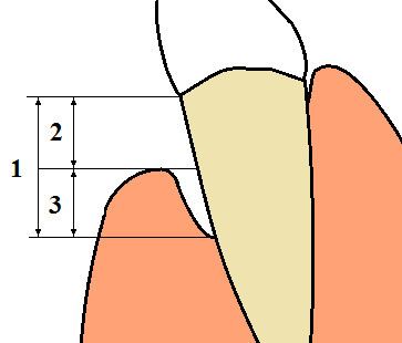 Gingival and periodontal pocket
