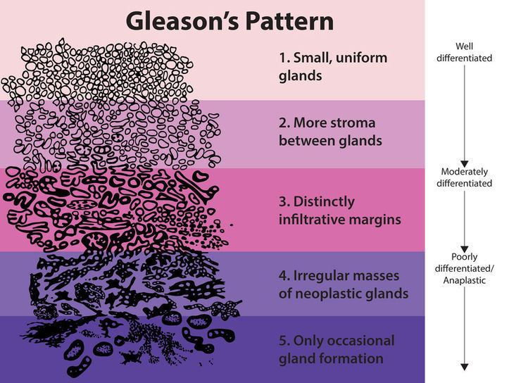 Gleason grading system