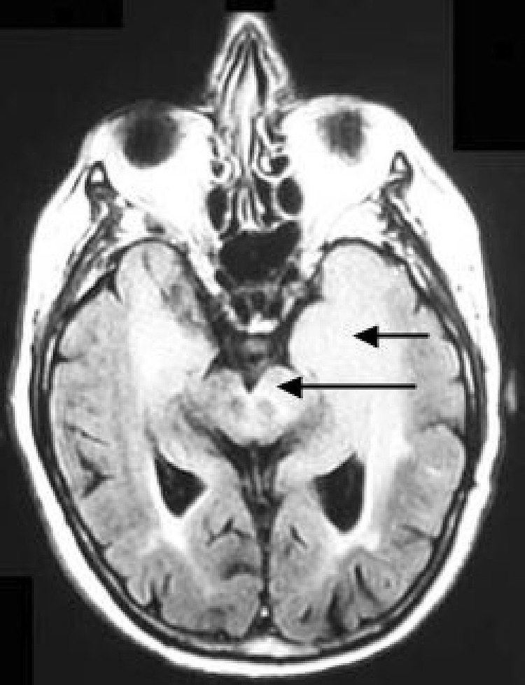 Gliomatosis cerebri
