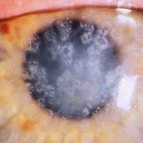 Granular corneal dystrophy