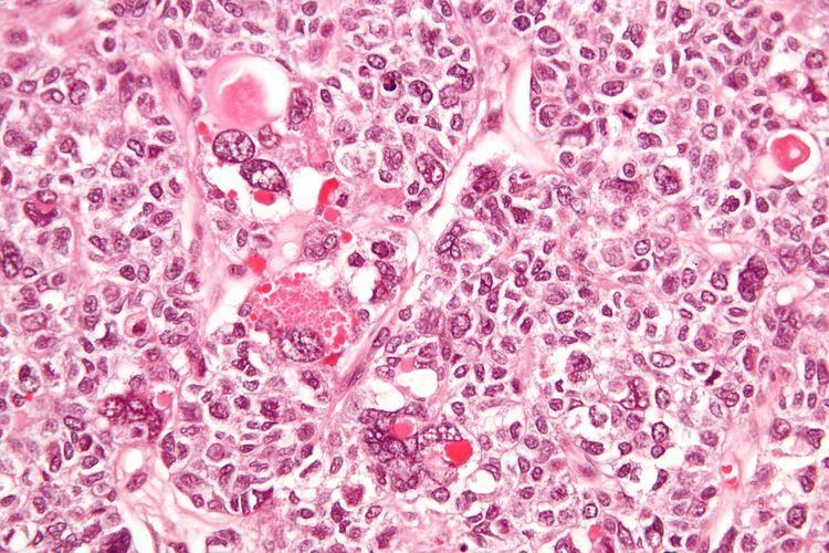 Granulosa cell tumour