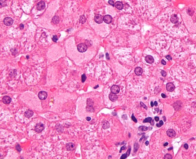 Ground glass hepatocyte